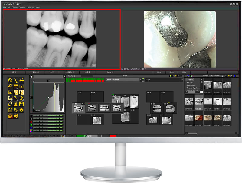 cadi xrays history