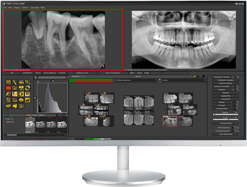 cadi xrays