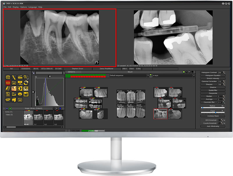 cadi xrays